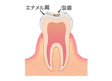 C1 エナメル質の虫歯