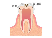 C2 像牙質の虫歯