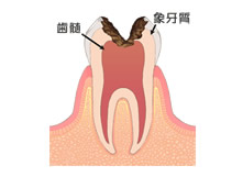 C3 歯髄（神経）まで進んだ虫歯