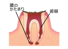 C4 歯根まで進んだ虫歯