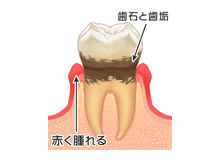 軽度歯肉炎