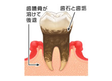 中等度歯周炎